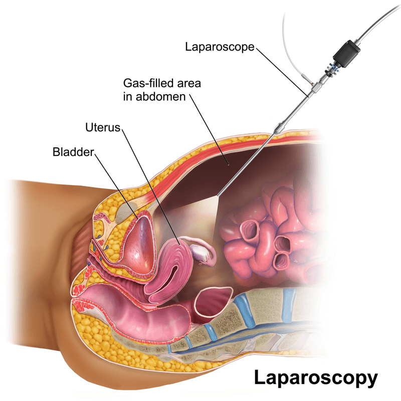 laparoskop endometrioza pojęcia