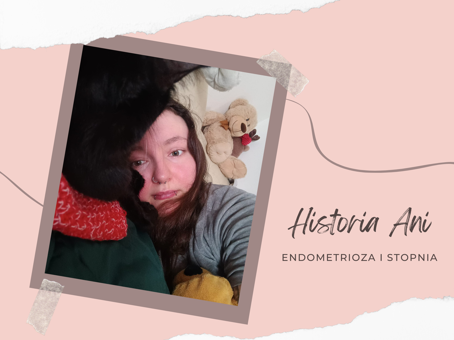 endometrioza I stopnia czy boli